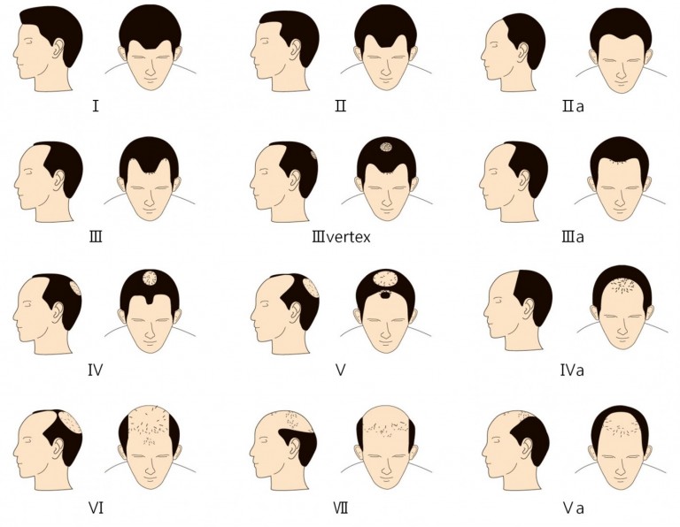 Norwood Chart Pattern Baldness
