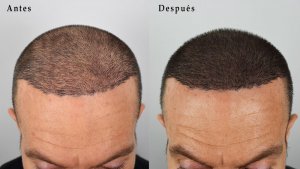 tratamiento de micropigmentacion para injerto trasplante capilar