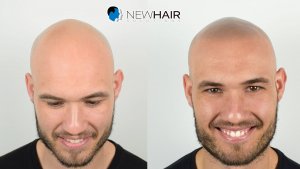 Micropigmentación capilar - Línea frontal -Grado alopecia Norwood 6