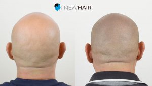 Micropigmentación capilar - Coronilla -Grado alopecia Norwood 6