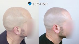 Micropigmentación capilar - laterales temples -Grado calvicie alopecia Norwood 6
