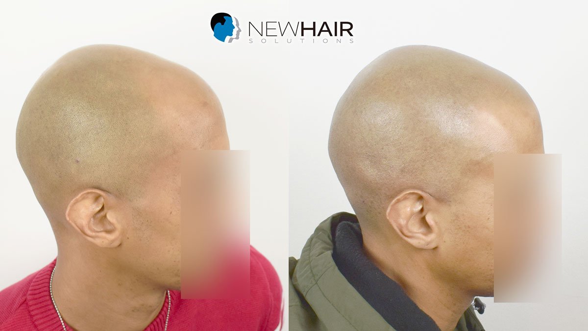 imagenes antes y despues micropigmentacion capilar